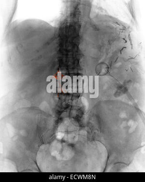 Bauch x-ray zeigt einen Vena Cava Blutgerinnsel Filter. Stockfoto