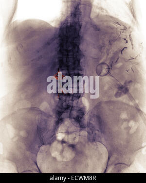 Bauch x-ray zeigt einen Vena Cava Blutgerinnsel Filter. Stockfoto