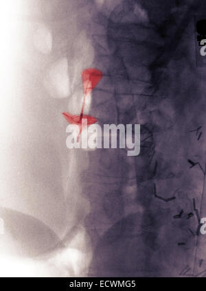 Bauch x-ray zeigt einen Vena Cava Blutgerinnsel Filter. Stockfoto