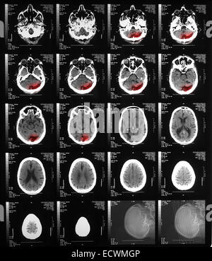 CT-Scan zeigt Atrophie der beiden Gehirnhälften Stockfoto