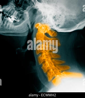 Normale HWS Röntgen. Stockfoto