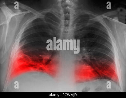 Röntgen-Thorax zeigt eine Lunge Infiltrat an einer Lungenentzündung. Stockfoto
