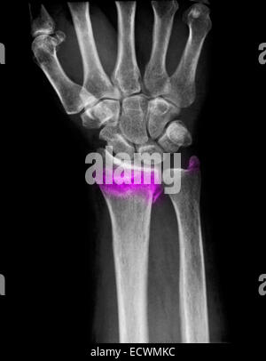 Handgelenk Röntgen zeigt einen gebrochenen distalen Radius und Ulna. Stockfoto