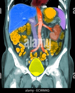 Koronale Rekonstruktionen von eine Computertomographie des Abdomens mit metastatischem Prostatakrebs. Stockfoto