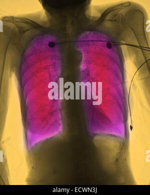 Röntgen-Thorax zeigt chronischen obstruktiven Lungenerkrankung. Stockfoto