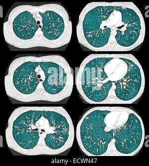 Zystische Fibrose Computertomographie axiale Ansicht. Stockfoto