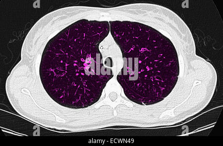 Zystische Fibrose Computertomographie axiale Ansicht. Stockfoto