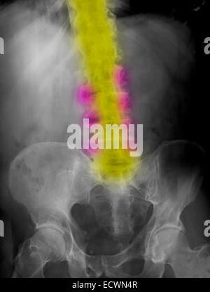 Lendenwirbelsäule Röntgenbild zeigt Arthrose und Knochen Sporen Stockfoto