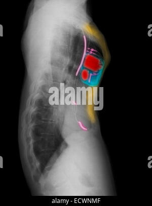 Brust Röntgen zeigt Schrittmacher für Vorhofflimmern. Stockfoto