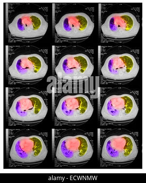 CT-Untersuchung der Brust mit einer Lungenentzündung. Stockfoto