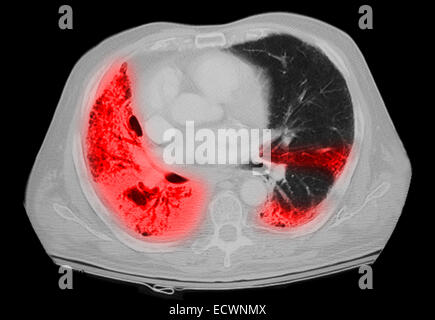 CT-Untersuchung der Brust mit einer Lungenentzündung. Stockfoto