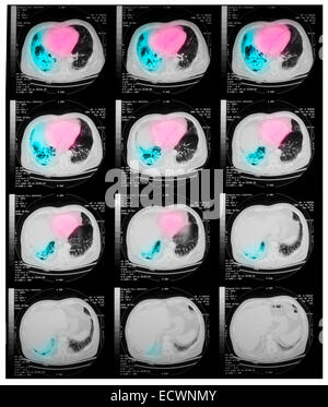 CT-Untersuchung der Brust mit einer Lungenentzündung. Stockfoto