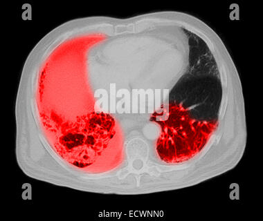 CT-Untersuchung der Brust mit einer Lungenentzündung. Stockfoto