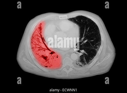 CT-Untersuchung der Brust mit einer Lungenentzündung. Stockfoto