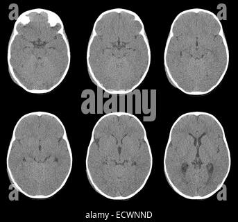 Kopf-CT zeigt einen Schädelbruch und eine subdurale Hämatom. Stockfoto