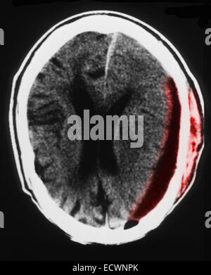 87 yo männlichen CT scan subdurale Hämatom und Gehirn Atrophie Stockfoto