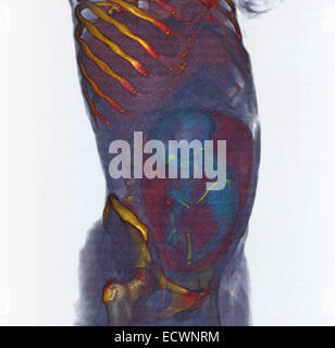 3D CT-Scan zeigt einen volle Amtszeit Fötus in Beckenendlage Stockfoto