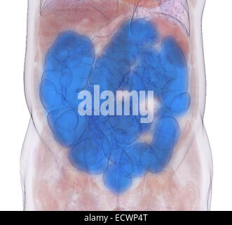 3D CT-Scan Bild eines CT-Koloskopie-Verfahrens. Stockfoto