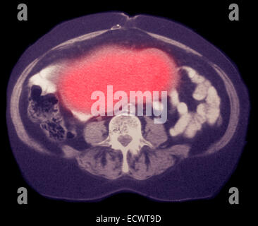 Eierstockkrebs auf CT-Scan. Stockfoto