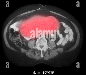 Eierstockkrebs auf CT-Scan. Stockfoto