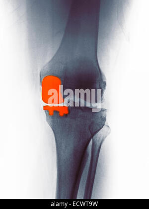 Knie Röntgen zeigt eine teilweise Kniegelenkersatz. Stockfoto