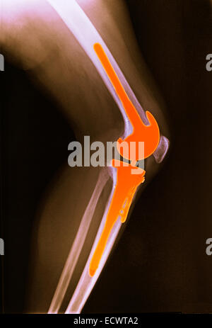 X-ray zeigt einer Knie-Totalprothese. Stockfoto