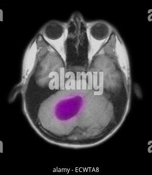 Pilocytic Astrozytom des Gehirns wie auf MRT-Scan zu sehen. Stockfoto