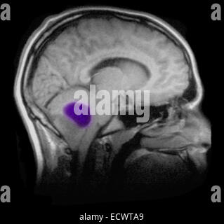 Pilocytic Astrozytom des Gehirns wie auf MRT-Scan zu sehen. Stockfoto