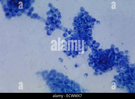 Gramm befleckt Schliffbild von pulmonale candidiasis Stockfoto