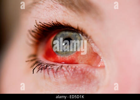Womans Auge mit gebrochenen Blutgefäß (subkonjunktivale Blutung) Stockfoto