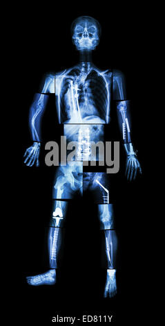 X-ray Ganzkörper und mehrere Frakturen. Er wurde betrieben und interne Fixierung durch Platte & Schraube Stockfoto