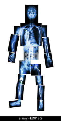 X-ray Ganzkörper und mehrere Frakturen. Er wurde betrieben und interne Fixierung durch Platte & Schraube Stockfoto