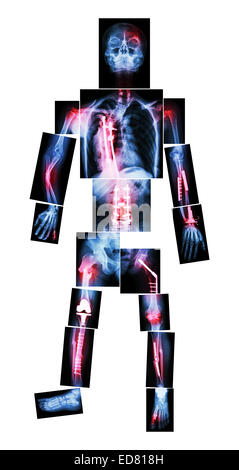 X-ray Ganzkörper und mehrere Frakturen. Er wurde betrieben und interne Fixierung durch Platte & Schraube Stockfoto