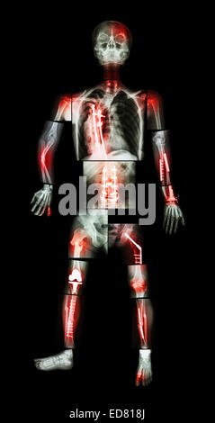 X-ray Ganzkörper und mehrere Frakturen. Er wurde betrieben und interne Fixierung durch Platte & Schraube Stockfoto