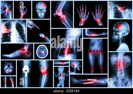 Sammlung Röntgen, mehrere menschliche Organ & orthopädische Chirurgie & mehrere Krankheit (Lungentuberkulose, Gicht, rheumatoide arth Stockfoto