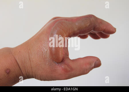 Männliche linke Hand hat Unfall, Verband an der linken Hand, Norfolk, Großbritannien Stockfoto