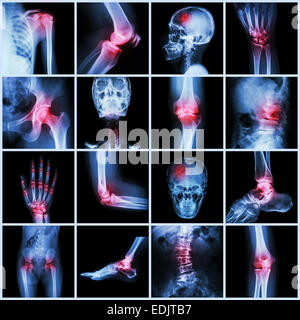 Sammlung menschlichen Gelenk und Arthritis und Schlaganfall (Schädel Kopf Hals Schulter Brust Thorax Schulter Arm Ellenbogen Unterarm Handgelenk Hand fi Stockfoto