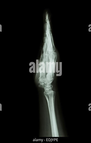 X-ray Hand & Unterarm AP (Lateral) (Seitenansicht) Stockfoto