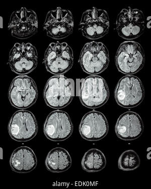 MRI Gehirn: Brain Tumor im rechten Scheitellappen Stockfoto