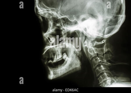 Film Röntgen Schädel seitlich: normalen menschliches Schädel und leeren Bereich auf der linken Seite zeigen Stockfoto