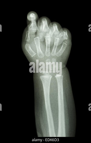 den Film Röntgen Unterarm und Hand: normales Kind Knochen zeigen Stockfoto