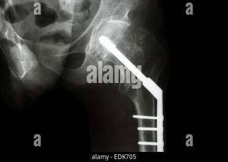 Film x-ray linke Hüfte: Hals Fraktur des Femur (Oberschenkelknochen) zu zeigen. Patient wurde betrieben und Knochen durch Schraube fixiert Stockfoto