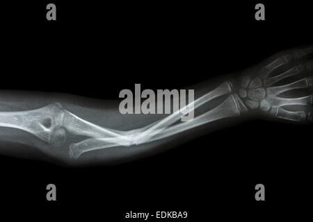 Film Röntgen Unterarm AP: Fraktur Welle des ulnaren zeigen (Unterarm Knochen) Stockfoto