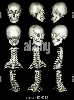 CT-Scan (Computertomographie-Tomographie) mit 3D Grafik zeigen normale menschliche Schädel und Halswirbelsäule Stockfoto