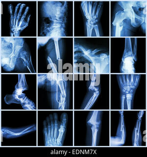 Kollektion Röntgen mehrere Knochenbrüche (Finger, Wirbelsäule, Handgelenk, Hüfte, Bein, Schlüsselbein, Knöchel, Ellenbogen, Arm, Fuß) Stockfoto