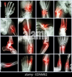 Kollektion Röntgen mehrere Knochenbrüche (Finger, Wirbelsäule, Handgelenk, Hüfte, Bein, Schlüsselbein, Knöchel, Ellenbogen, Arm, Fuß) Stockfoto