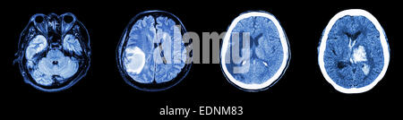 Sammlung-CT-Scan des Gehirns und mehrere Krankheiten (von links nach rechts: normale Gehirn, Hirninfarkt, Hirntumor, Intrazerebrale h Stockfoto