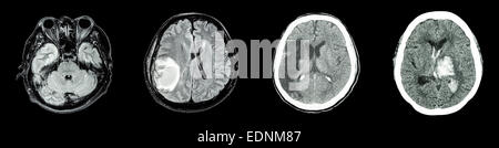 Sammlung-CT-Scan des Gehirns und mehrere Krankheiten (von links nach rechts: normale Gehirn, Hirninfarkt, Hirntumor, Intrazerebrale h Stockfoto