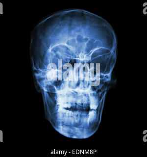 x-ray Asiaten Schädel (Thais) Film Stockfoto