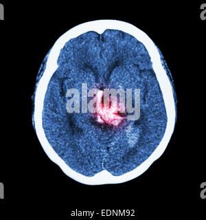 CT-Scan des Gehirns: hämorrhagischen Schlaganfall zeigen Stockfoto